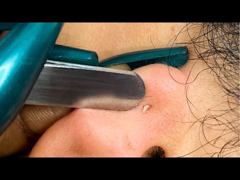 ASMR |Ear Check-up, Picking and Gentle Cleaning 🧼