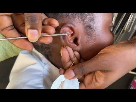 ASMR EAR CLEANING VERY SATISFYING FOR THOSE WHO NEED QUICK SLEEP WITH GUMCHEWING