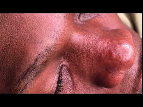 Asmr ~Nitpicking Whiteheads and pimples On My Brothers Nose. #asmr #whitehead #pimplesremoval
