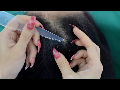 ASMR Dandruff Scratching, Scalp Scratching, Head Scratching ( No Talking )