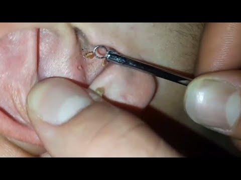 CLEANING OF HUGE BLACK DOTS and skin care asmr massage head massage