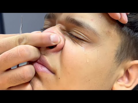 He Cried While Cleaning the Blackheads on His Nose ASMR Barber Massage