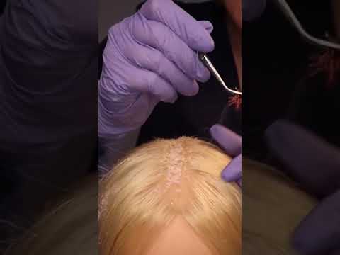 ASMR Scalp Check, Lice Removal & Treatment: Satisfyingly GOOD!! #asmr #bebravebeyouasmr #asmrscalp