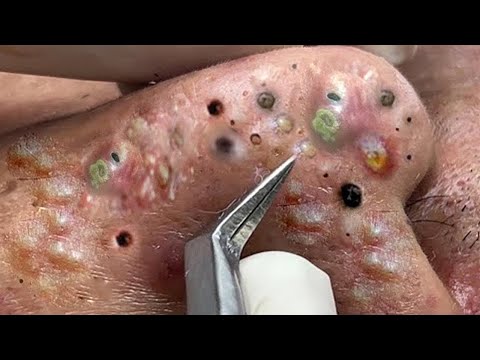 SATISFYING AND RELAXING PIMPLE POP COMPILATION | PART 26
