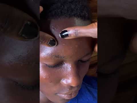 Hug Pimple popping #asmr #satisfying #asmrvideos #skincare