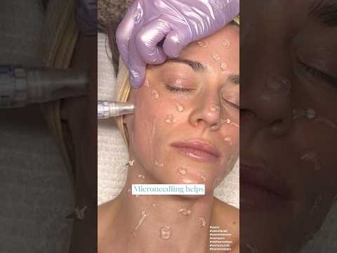 Skinpen Microneedling