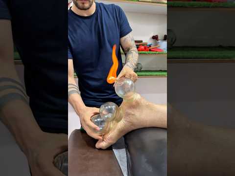 WoW Hot cupping😍#explore #cupping #fire #viral #trending #viralshorts #shorts
