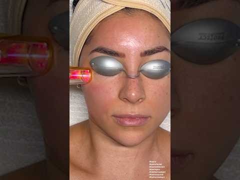 ASMR Facial Laser Treatment on Jeanine Amapola