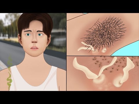 Laser hair removal|| dark armpit treatment|| smelly armpit|| ASMR animation||