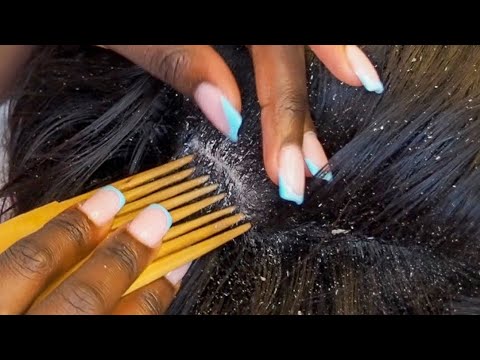 ASMR Scalp Scratching ~ Super Intense Head TINGLES💆🏼‍♂️