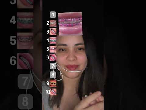 ranque aparelho  #asmr