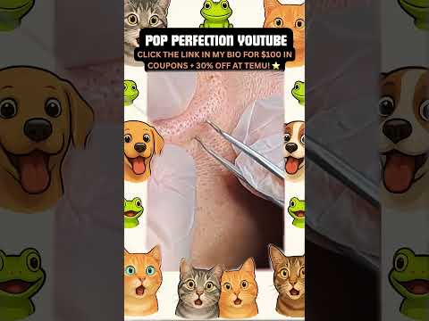 Wow! #pimpleremoval #pimple #pimples #shortsfeed #shortvideo #shorts #short #youtube #youtubeshorts