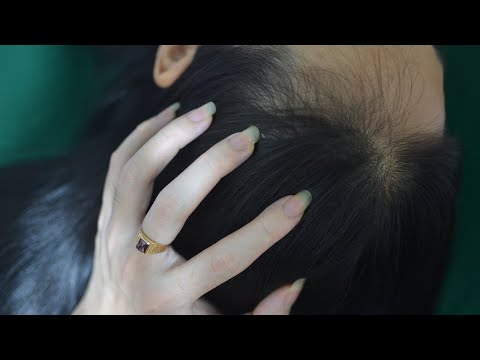 ASMR Scalp Scratching, Head Scratching Massage, Therapy Sounds For Headache Relief