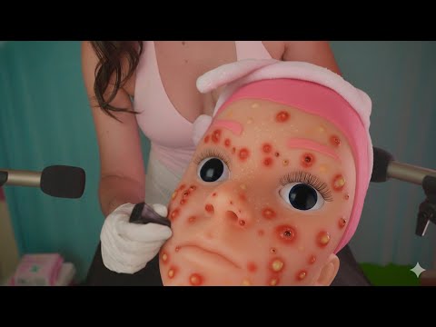 ASMR Espinhas GIGANTES 😳 Extração INTENSA de furúnculos e cravos
