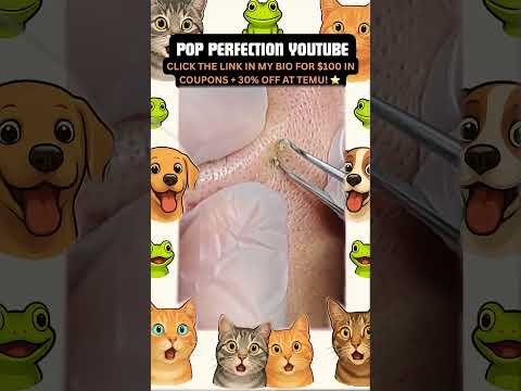 Wow! #pimpleremoval #pimple #pimples #shortsfeed #shortvideo #shorts #short #youtube #youtubeshorts