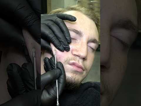 BARBER ACNE REMOVAL & SKIN CARE, MASSAGE #asmr #blackheads #skincare #massage #cracks #removal
