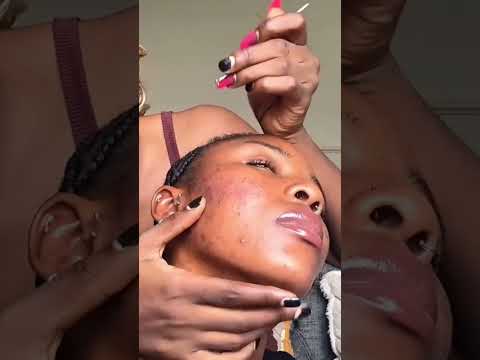 Asmr pimple Popping #relax