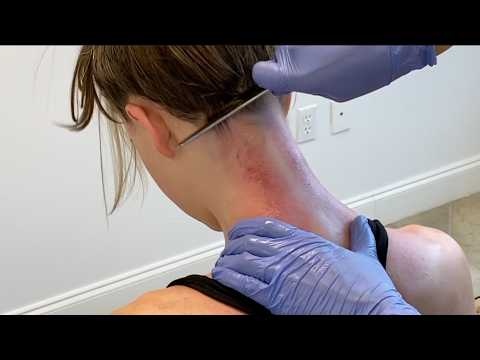 Scraping and CRACKING Away Years of Neck Pain (Gua Sha Therapy)