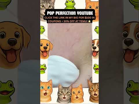 Wow! #pimpleremoval #pimple #pimples #shortsfeed #shortvideo #shorts #short #youtube #youtubeshorts