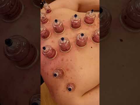 The sounds of Cupping Therapy #asmr #shorts