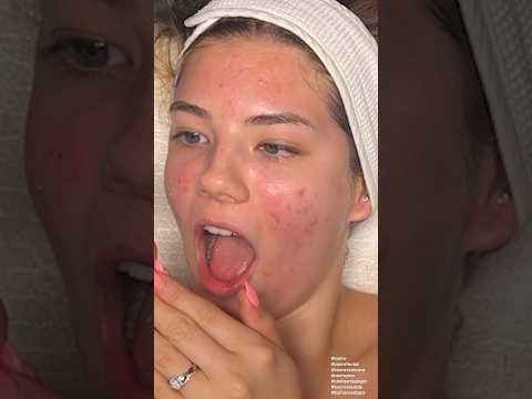 ASMR Facial Pimple Popping with @katemariess @harperzilmer