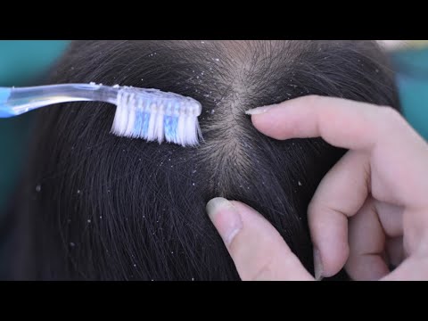 ASMR Scalp Scratching, Scalp Check, Scalp Massage Real Person For Relaxation ( No Talking )