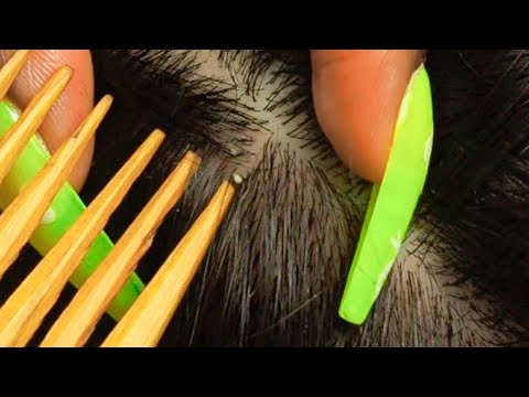 {ASMR} Rare & Specific NITPICKING | ATTENTIVE Scalp Inspection triggers 😴
