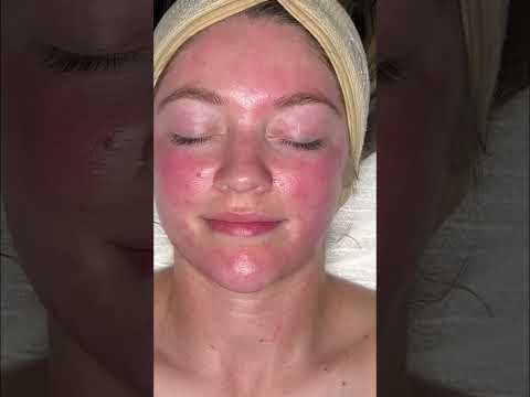 Fight Acne & Wrinkles: The Retinol Secret Revealed! #shorts