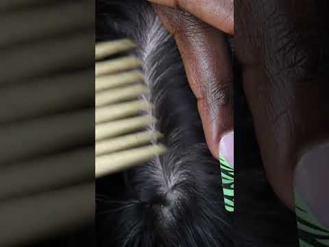 🥱🛌💤 Ultimate satisfying NITPICKING &SCRATCHING whiteheads from his scalp #asmr #fyp  #viral