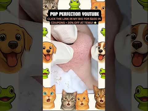 Wow! #pimpleremoval #pimple #pimples #shortsfeed #shortvideo #shorts #short #youtube #youtubeshorts