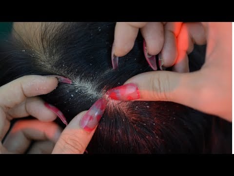 ASMR Satisfying Scalp Check / Dandruff Scratching Make You Feel Relax And Fall Asleep