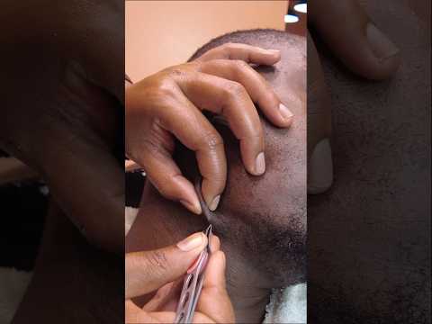ASMR: Close-Up Blackhead & Ingrown Hair Removal