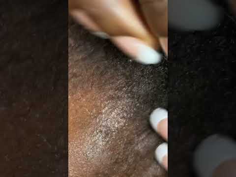 Asmr scalp Scratching #asmr #scratch #dandruff
