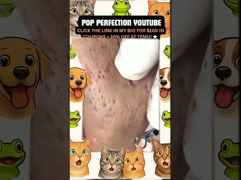 Wow! #pimpleremoval #pimple #pimples #shortsfeed #shortvideo #shorts #short #youtube #youtubeshorts