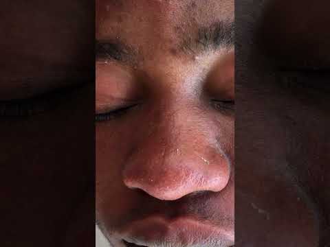 Nitpicking whiteheads on the nose #satisfying #whiteheads #nitpicking