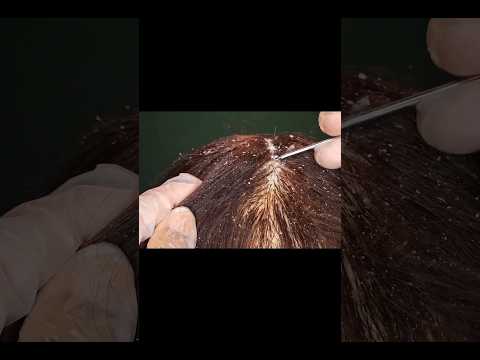 ASMR - ENFERMEIRA DA UPA TIRA CASPAS DO SEU CABELO #asmr #asmrshorts #shorts #shortvideo