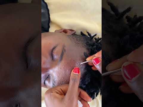 Asmr pimple popping whiteheads and blackheads #asmr #tingling #asmrvideos #nitpicking #satisfying