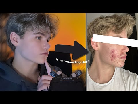 ASMR │ How I Got Rid Of Acne💊 (My Skin Journey & Skincare Routine + Pictures)