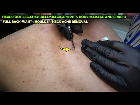 💈BARBER EPIC SHOULDER & BACK ACNE REMOVAL + CRACKS + ASMR chest, foot, head, armpit & body massage