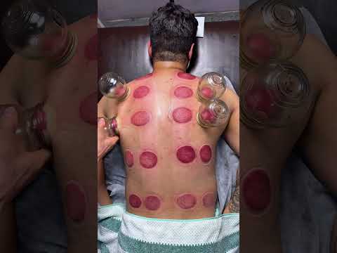 wow pizza peperoni Cupping#shorts #cupping #asmr #explore #youtubeshorts #cuppingtherapy