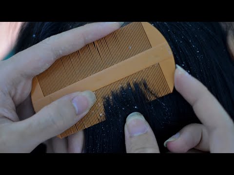 ASMR Dandruff Scratching And Combing / Through Dandruff, Scalp Check Flare Up