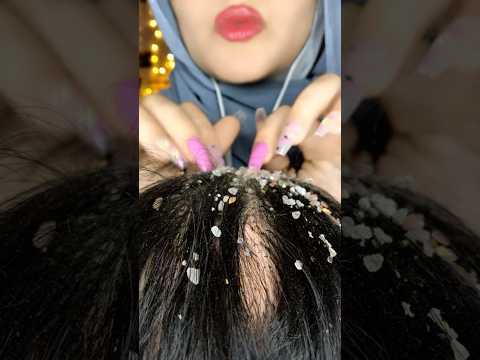 Dandruff Removal🥶💆🏻‍♀️#asmr #relaxing #visualtingle #satisfying#mouthwhisper #asmrmassage #shorts