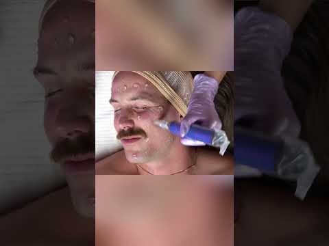 Extreme Dermapen ASMR: Painful Needles & Red Skin Reveal! #shorts