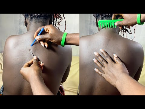 ASMR BACK NIPICKING AND SCRATCHING