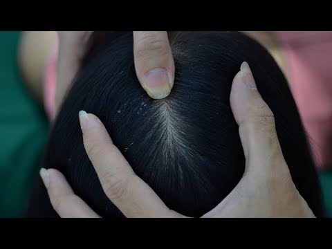 ASMR Scalp Scratching Fast And Aggressive / Dandruff Scratching For Relaxation