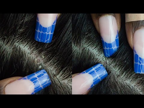ASMR Deep Concentration Nitpicking, Scratching & softly blowing at your scalp ~ whispers 🐣 special.