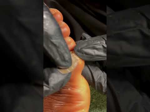 ASMR FOOT MASSAGE AND RELAXING PEDICURE, CORN REMOVAL AND NAILS CUTTING VERY RELAXING