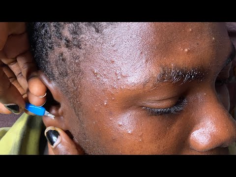 Asmr A Rare Ear Hole Nitpicking,🙊😦😳-Relaxing Sound