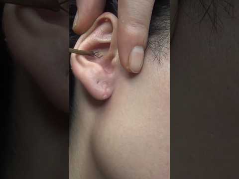 LADY I TOOK LOT OF OIL FROM EAR - CRACKS - HAIR WASH #earcleaning #kulaktemizliği #asmrcleaning