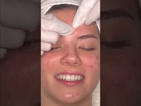 Satisfying Pore Extractions: Clear Your Clogged Pores! #shorts